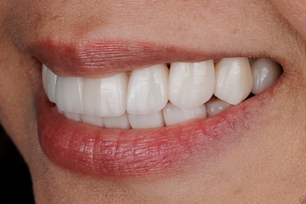 Benefits Of Dental Veneers
