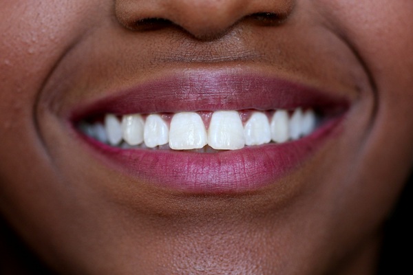 How Teeth Whitening Targets Discoloration And Stain